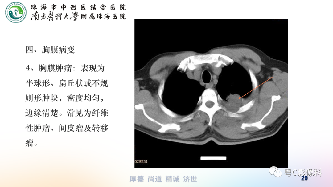 影像PPT - 【PPT】呼吸系统基本病变影像学表现-29