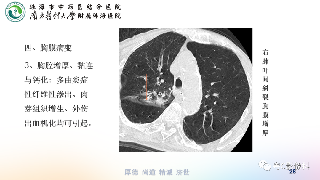 影像PPT - 【PPT】呼吸系统基本病变影像学表现-28