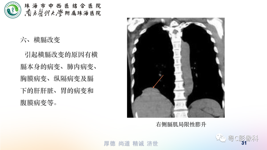 影像PPT - 【PPT】呼吸系统基本病变影像学表现-31