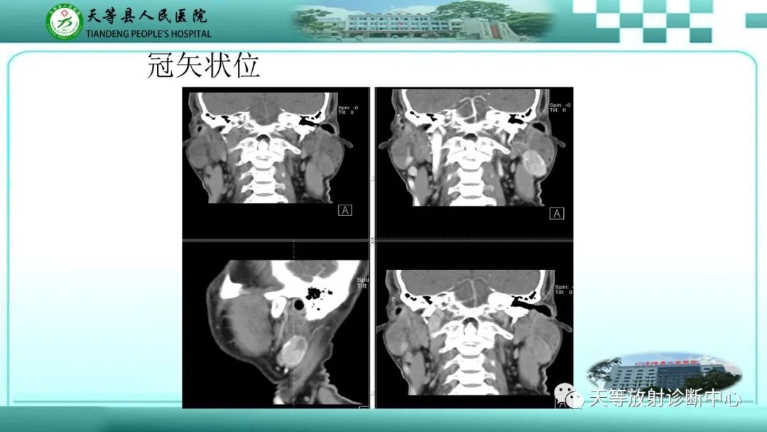 影像PPT - 【PPT】腮腺淋巴瘤(Warthin瘤)的影像学表现-5 影像PPT - 【PPT】腮腺淋巴瘤(Warthin瘤)的影像学表现-5