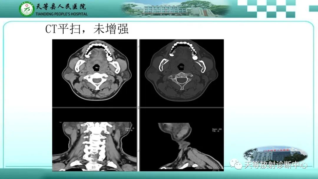 影像PPT - 【PPT】腮腺淋巴瘤(Warthin瘤)的影像学表现-8 影像PPT - 【PPT】腮腺淋巴瘤(Warthin瘤)的影像学表现-8