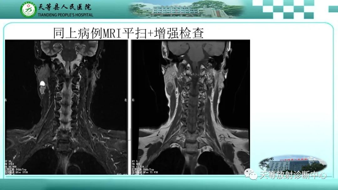 影像PPT - 【PPT】腮腺淋巴瘤(Warthin瘤)的影像学表现-10 影像PPT - 【PPT】腮腺淋巴瘤(Warthin瘤)的影像学表现-10