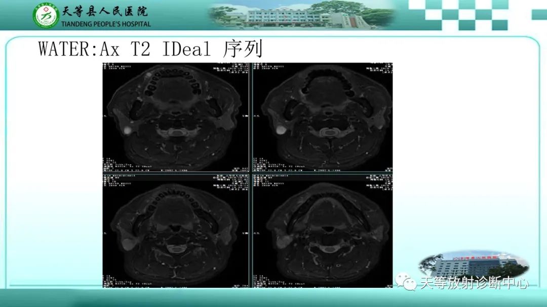 影像PPT - 【PPT】腮腺淋巴瘤(Warthin瘤)的影像学表现-11 影像PPT - 【PPT】腮腺淋巴瘤(Warthin瘤)的影像学表现-11