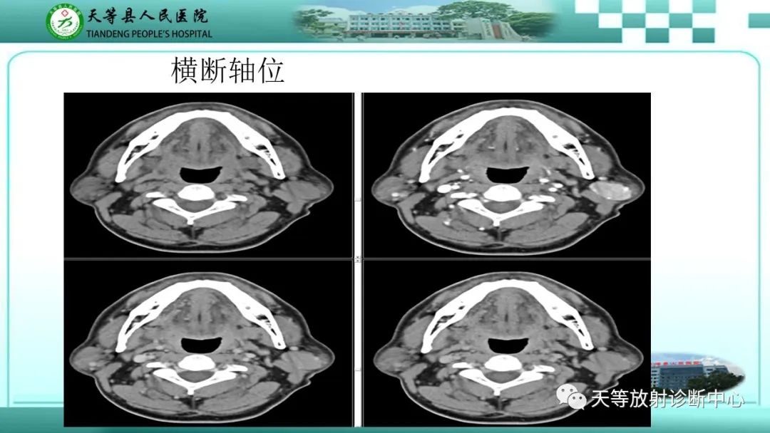 影像PPT - 【PPT】腮腺淋巴瘤(Warthin瘤)的影像学表现-4 影像PPT - 【PPT】腮腺淋巴瘤(Warthin瘤)的影像学表现-4