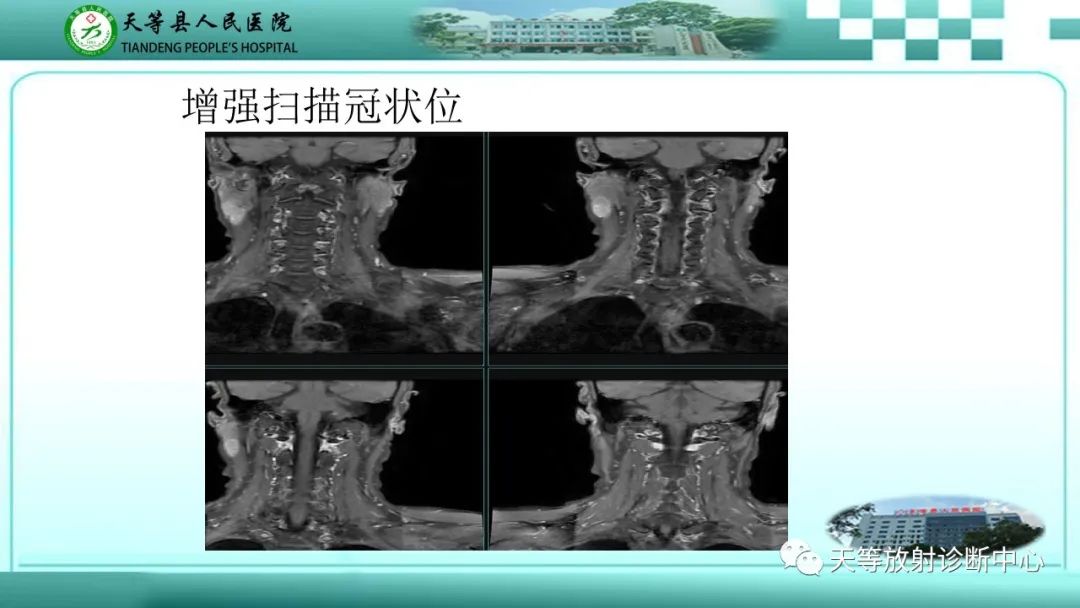 影像PPT - 【PPT】腮腺淋巴瘤(Warthin瘤)的影像学表现-14 影像PPT - 【PPT】腮腺淋巴瘤(Warthin瘤)的影像学表现-14
