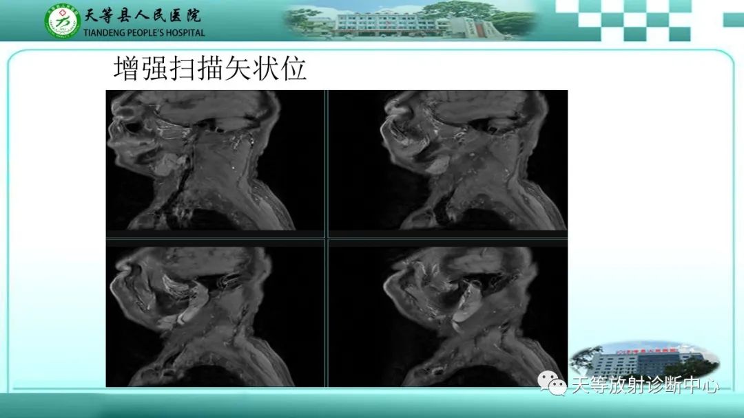 影像PPT - 【PPT】腮腺淋巴瘤(Warthin瘤)的影像学表现-15 影像PPT - 【PPT】腮腺淋巴瘤(Warthin瘤)的影像学表现-15