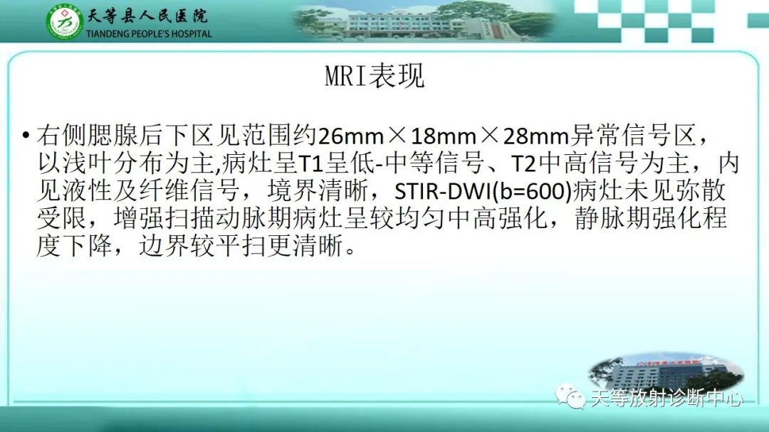 影像PPT - 【PPT】腮腺淋巴瘤(Warthin瘤)的影像学表现-9 影像PPT - 【PPT】腮腺淋巴瘤(Warthin瘤)的影像学表现-9