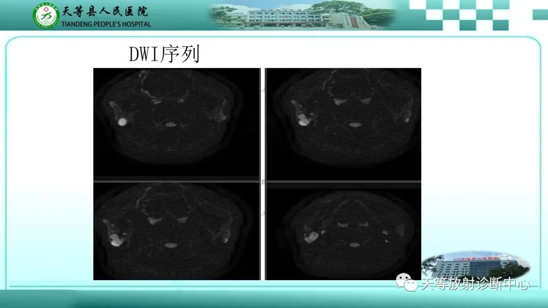影像PPT - 【PPT】腮腺淋巴瘤(Warthin瘤)的影像学表现-16 影像PPT - 【PPT】腮腺淋巴瘤(Warthin瘤)的影像学表现-16