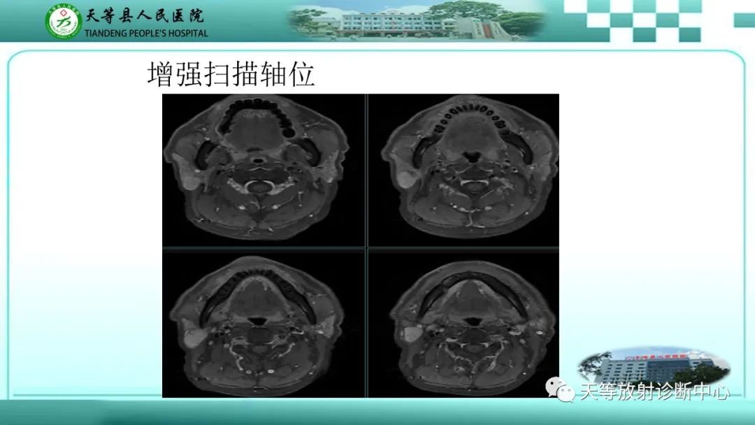影像PPT - 【PPT】腮腺淋巴瘤(Warthin瘤)的影像学表现-13 影像PPT - 【PPT】腮腺淋巴瘤(Warthin瘤)的影像学表现-13