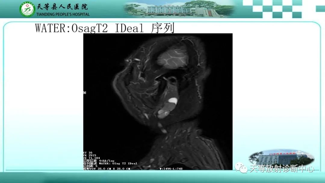 影像PPT - 【PPT】腮腺淋巴瘤(Warthin瘤)的影像学表现-12 影像PPT - 【PPT】腮腺淋巴瘤(Warthin瘤)的影像学表现-12