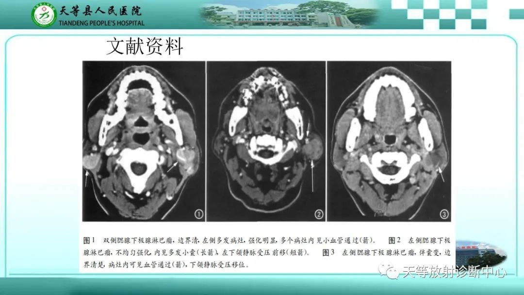 影像PPT - 【PPT】腮腺淋巴瘤(Warthin瘤)的影像学表现-18 影像PPT - 【PPT】腮腺淋巴瘤(Warthin瘤)的影像学表现-18