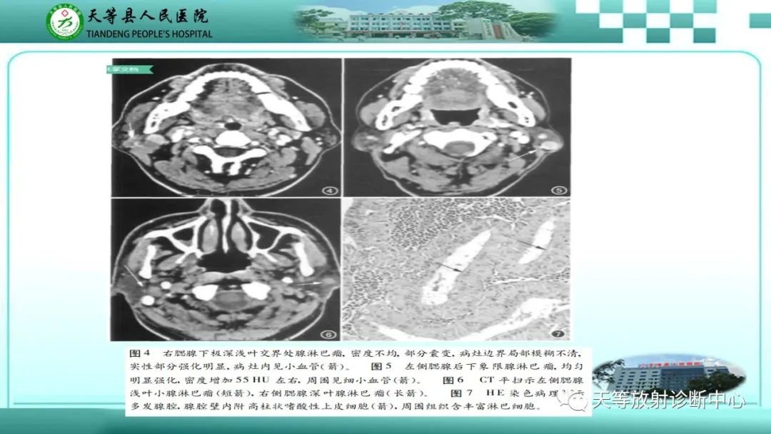 影像PPT - 【PPT】腮腺淋巴瘤(Warthin瘤)的影像学表现-19 影像PPT - 【PPT】腮腺淋巴瘤(Warthin瘤)的影像学表现-19