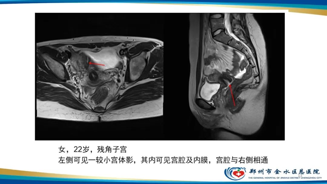 影像PPT - 【PPT】先天性子宫畸形分型及影像表现-13