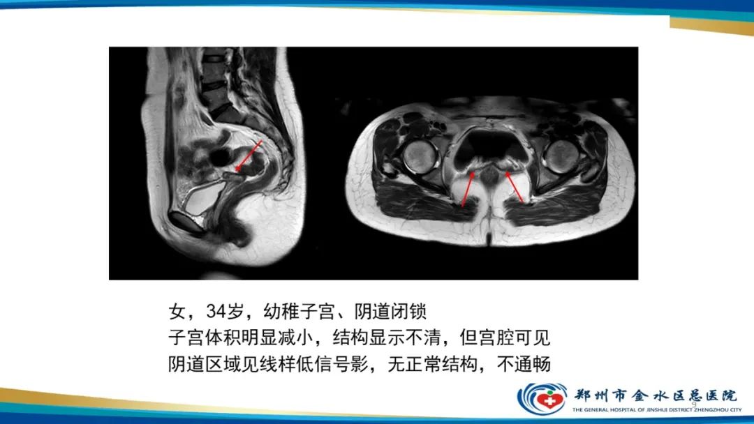 影像PPT - 【PPT】先天性子宫畸形分型及影像表现-9