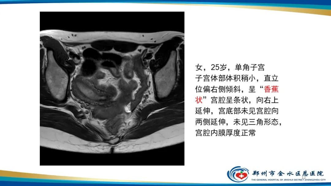 影像PPT - 【PPT】先天性子宫畸形分型及影像表现-12