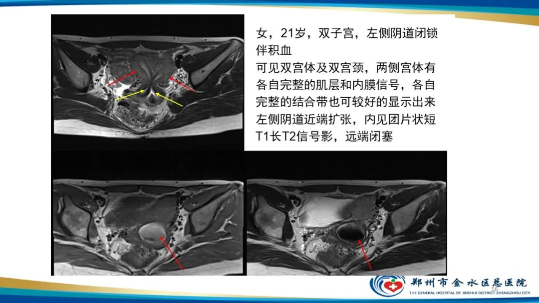 影像PPT - 【PPT】先天性子宫畸形分型及影像表现-16