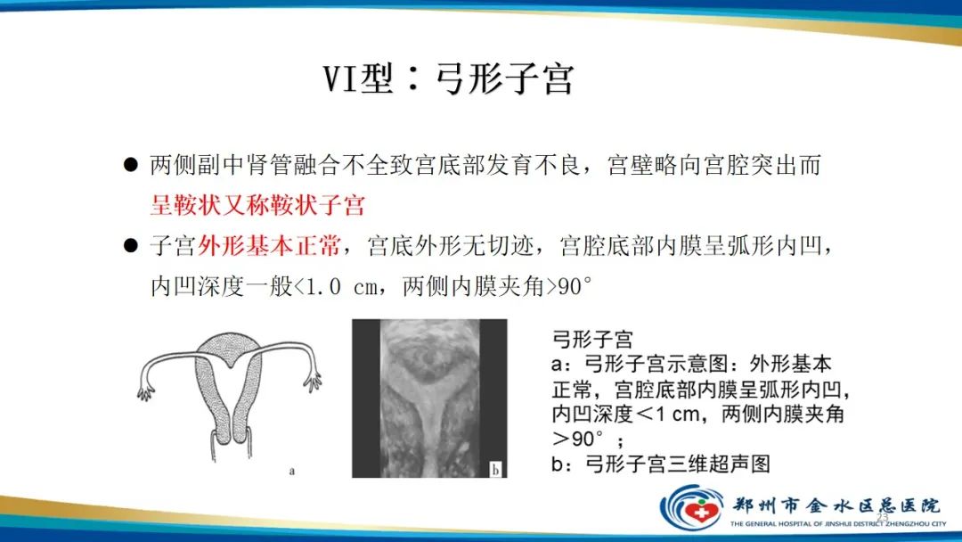 影像PPT - 【PPT】先天性子宫畸形分型及影像表现-23