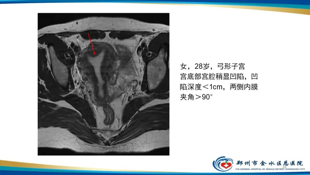 影像PPT - 【PPT】先天性子宫畸形分型及影像表现-24