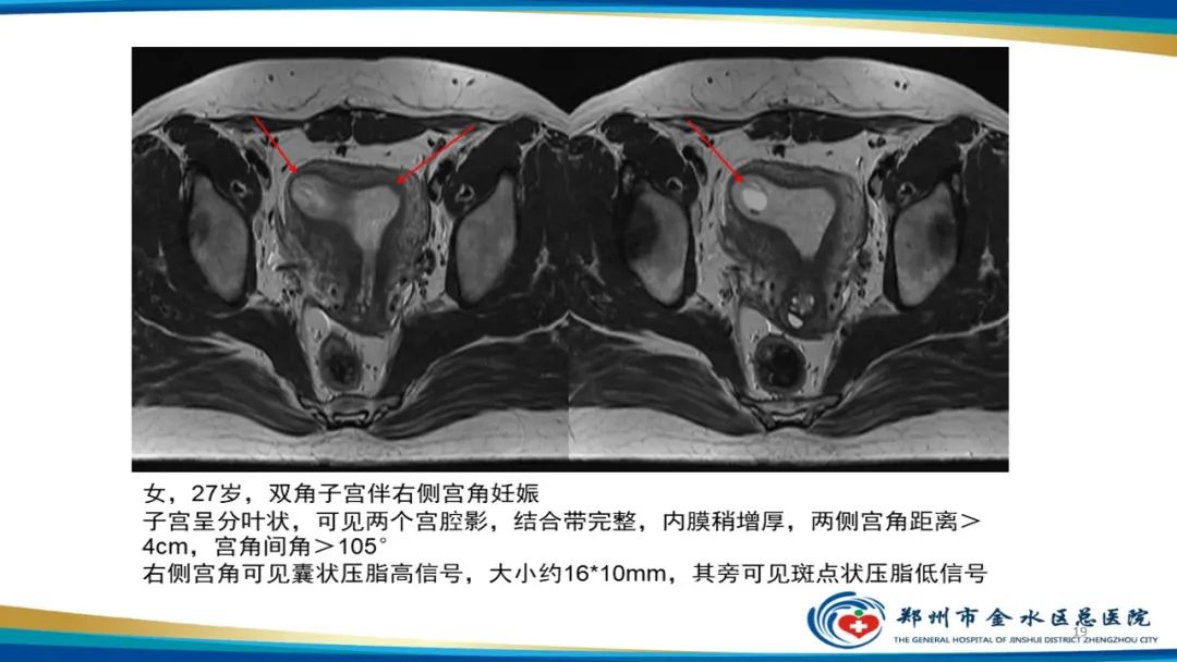 影像PPT - 【PPT】先天性子宫畸形分型及影像表现-19