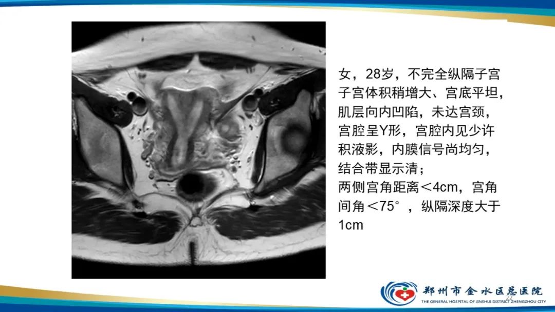 影像PPT - 【PPT】先天性子宫畸形分型及影像表现-22