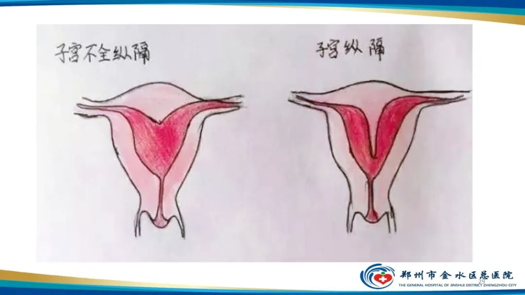 影像PPT - 【PPT】先天性子宫畸形分型及影像表现-29