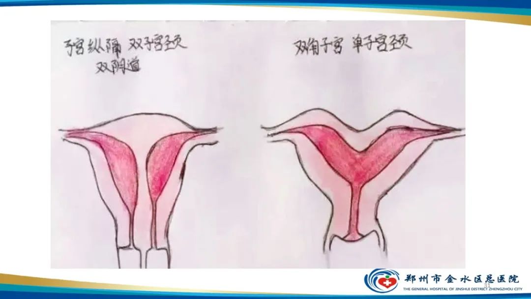 影像PPT - 【PPT】先天性子宫畸形分型及影像表现-31