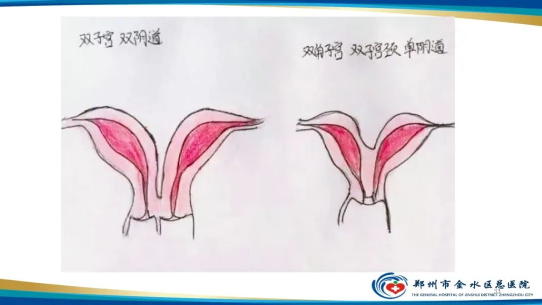 影像PPT - 【PPT】先天性子宫畸形分型及影像表现-33