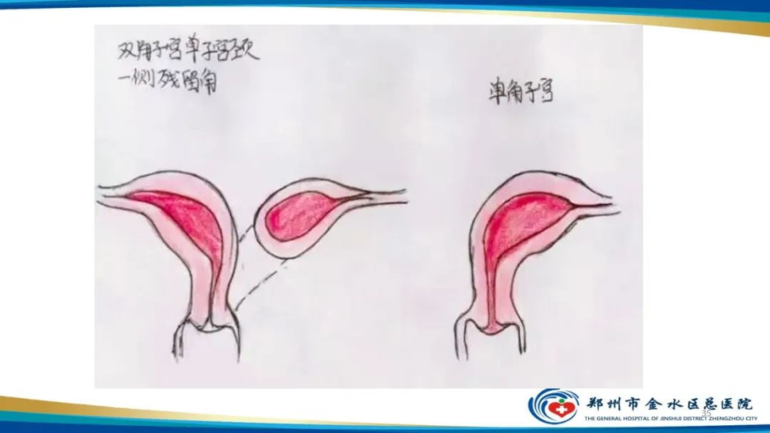 影像PPT - 【PPT】先天性子宫畸形分型及影像表现-35