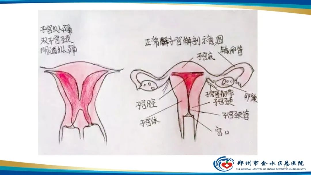 影像PPT - 【PPT】先天性子宫畸形分型及影像表现-37
