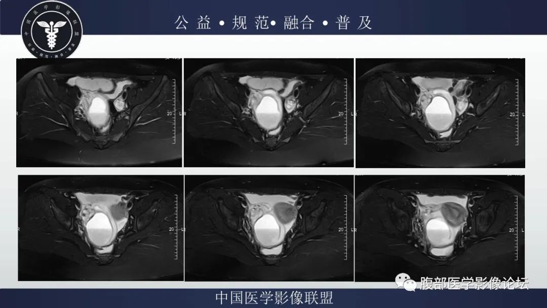 影像PPT - 【病例】输卵管积脓1例MR影像-4
