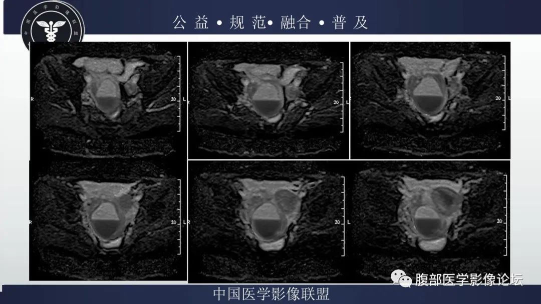 影像PPT - 【病例】输卵管积脓1例MR影像-8