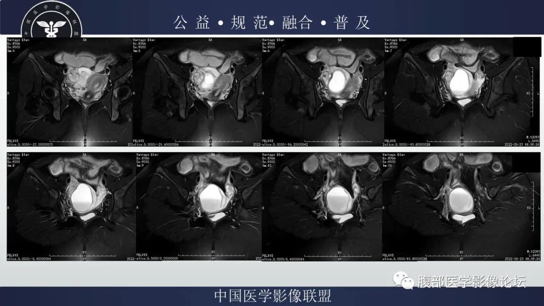 影像PPT - 【病例】输卵管积脓1例MR影像-9