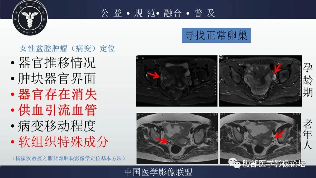 影像PPT - 【病例】输卵管积脓1例MR影像-10