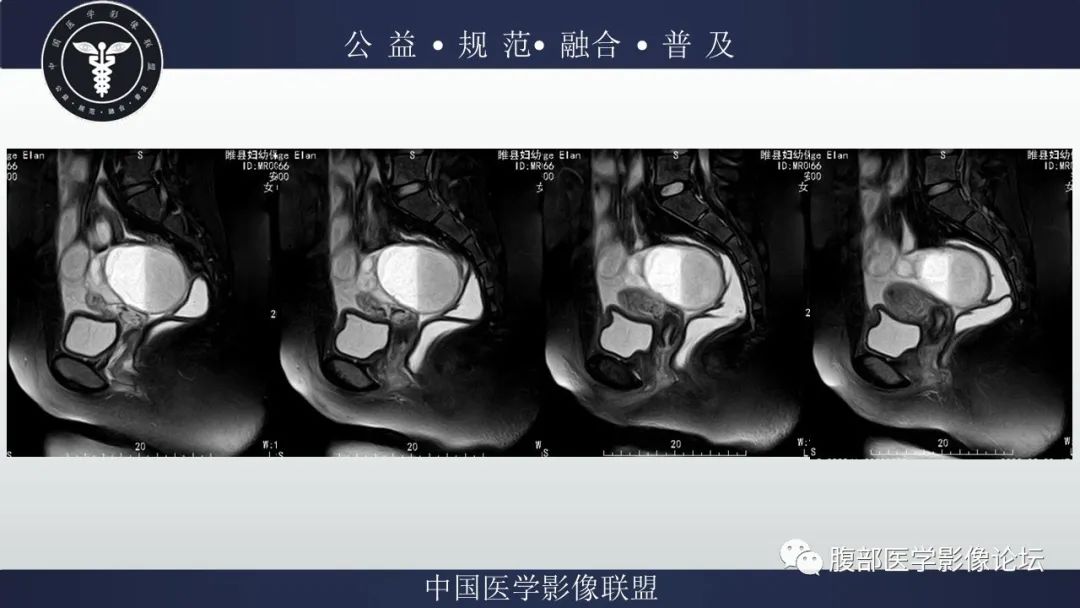 影像PPT - 【病例】输卵管积脓1例MR影像-3
