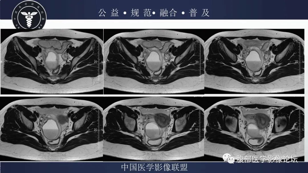 影像PPT - 【病例】输卵管积脓1例MR影像-5
