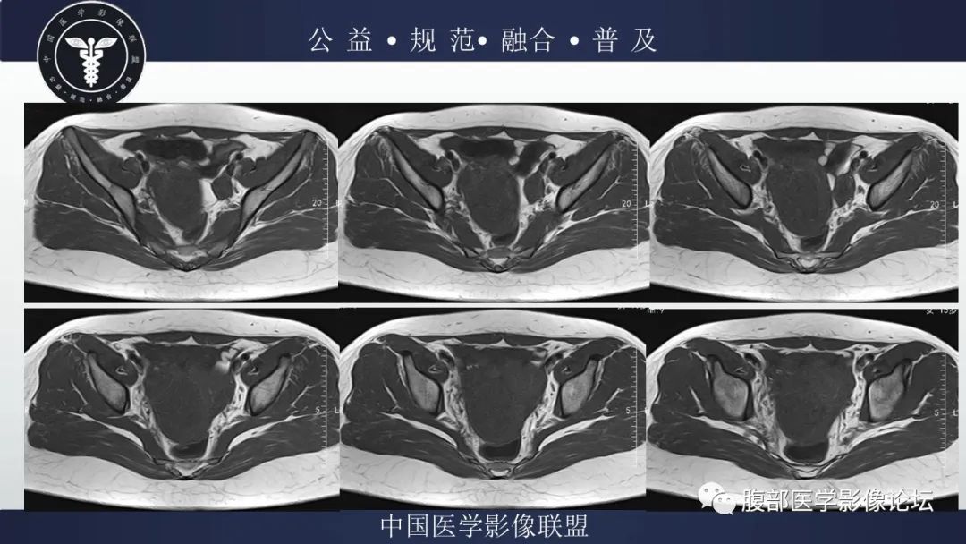 影像PPT - 【病例】输卵管积脓1例MR影像-6