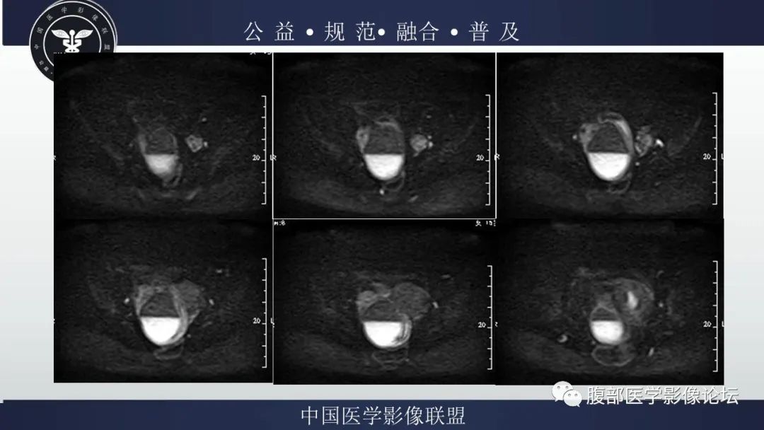 影像PPT - 【病例】输卵管积脓1例MR影像-7