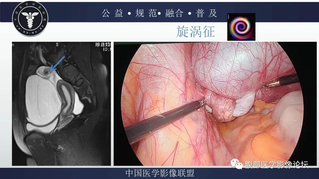 影像PPT - 【病例】输卵管积脓1例MR影像-17