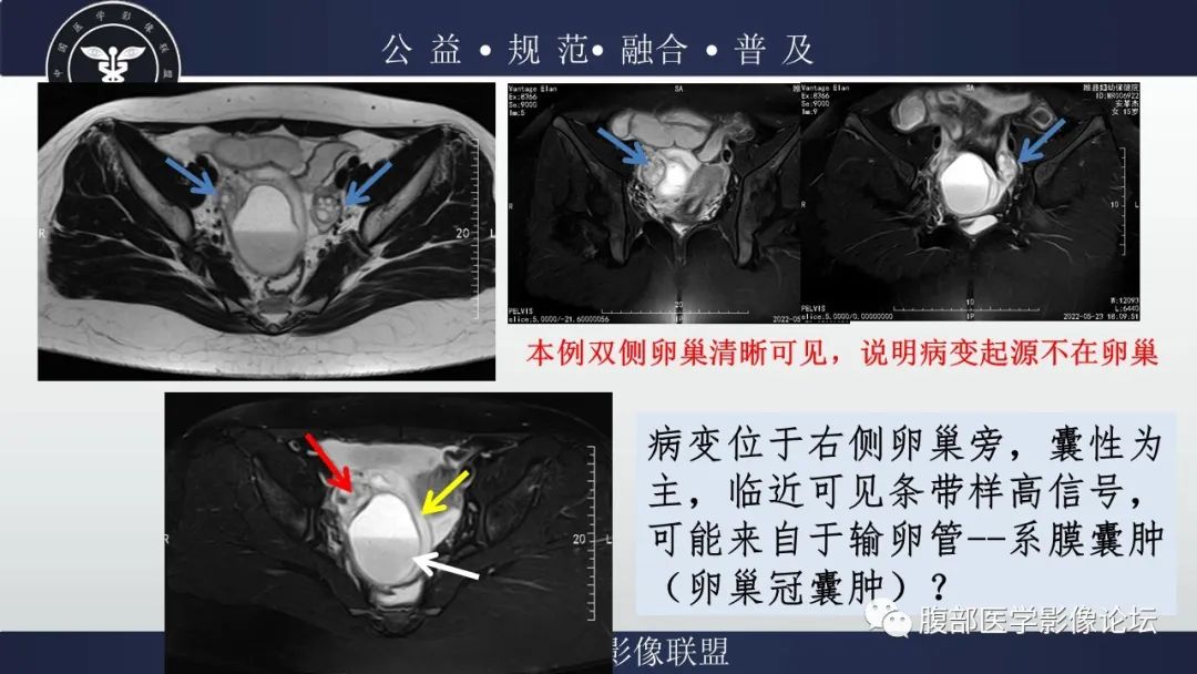 影像PPT - 【病例】输卵管积脓1例MR影像-11