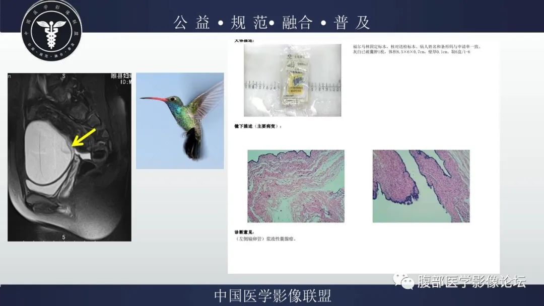 影像PPT - 【病例】输卵管积脓1例MR影像-18
