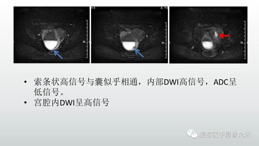 影像PPT - 【病例】输卵管积脓1例MR影像-13