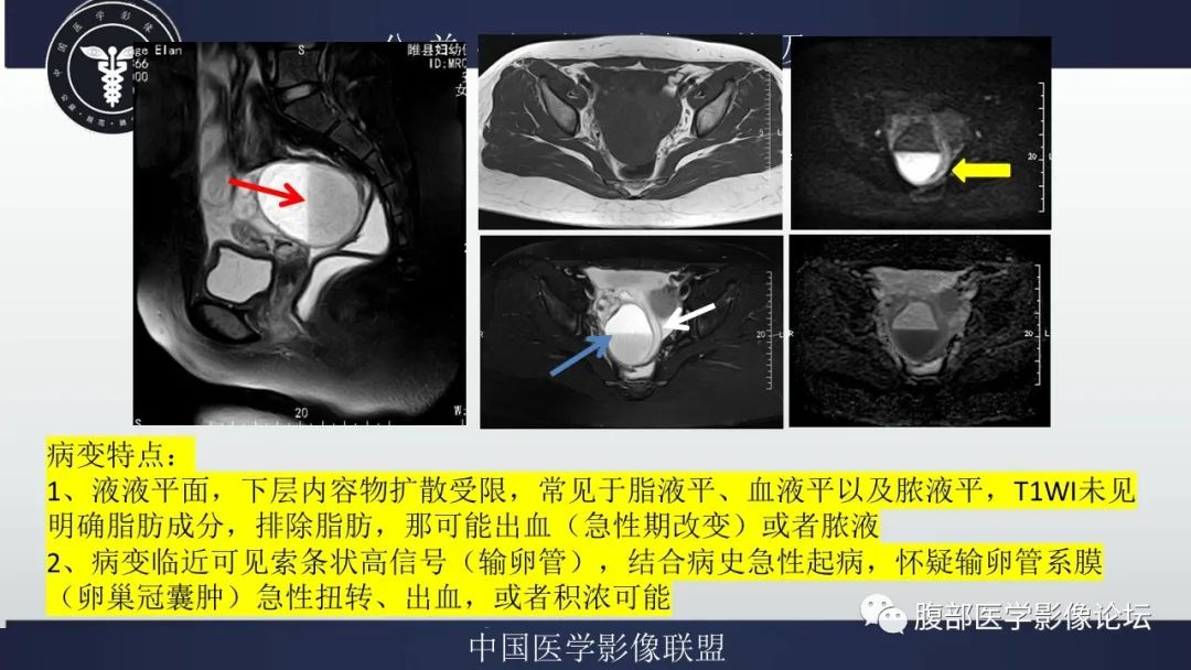 影像PPT - 【病例】输卵管积脓1例MR影像-12