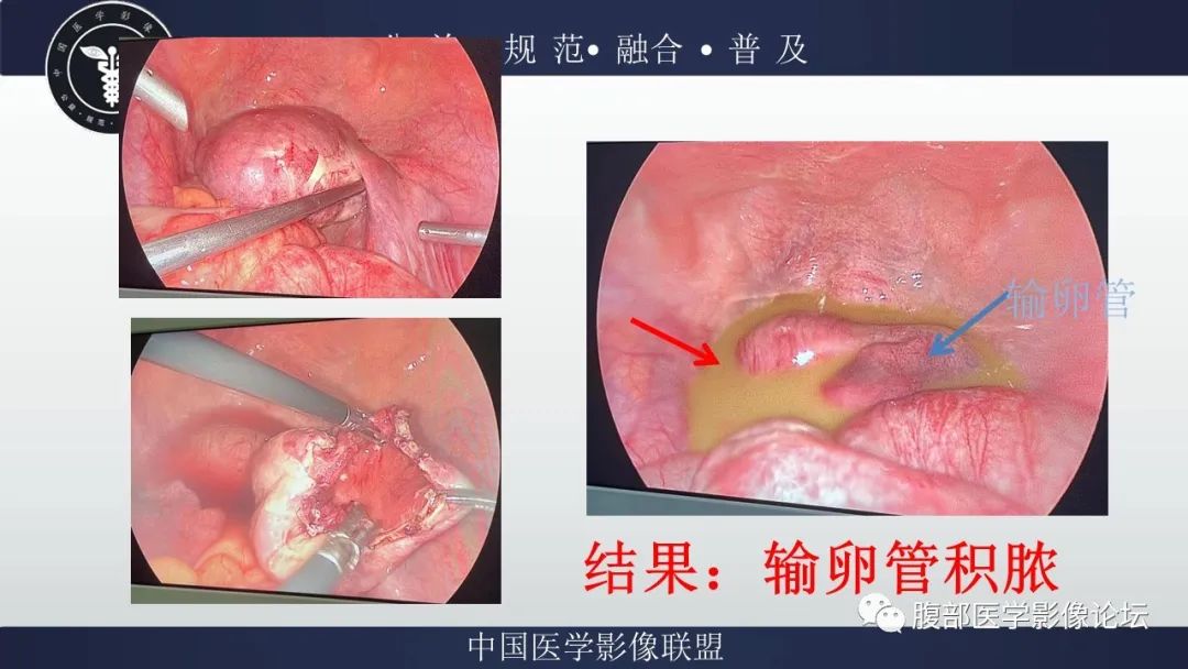 影像PPT - 【病例】输卵管积脓1例MR影像-15