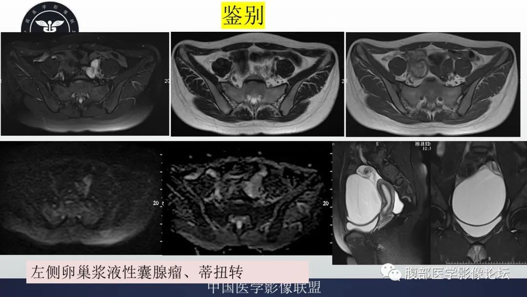 影像PPT - 【病例】输卵管积脓1例MR影像-16