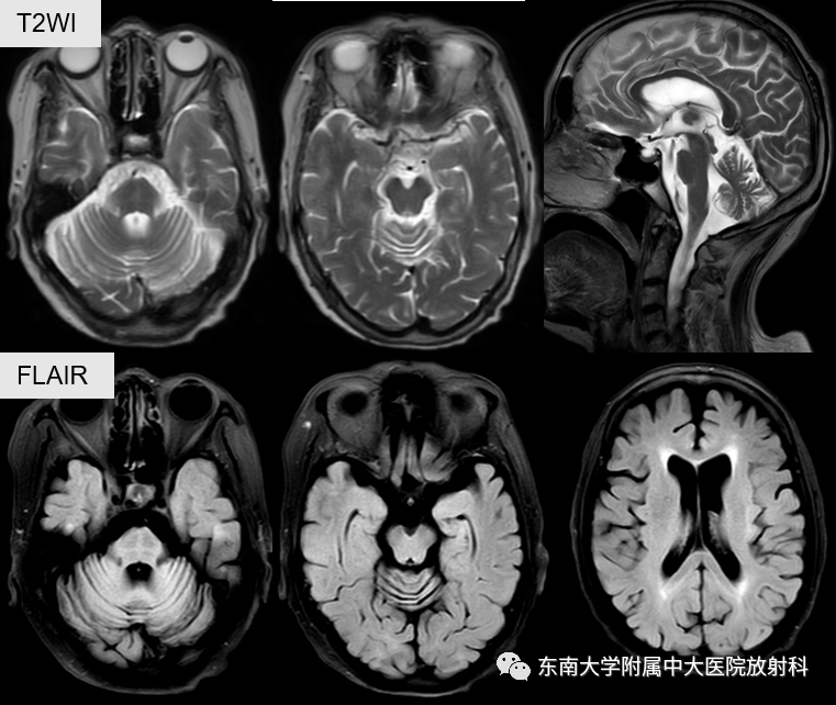 影像PPT - 【PPT】多系统萎缩-1