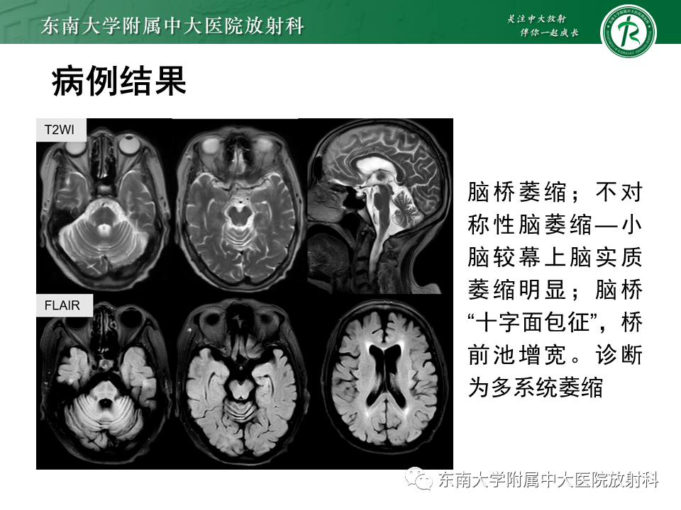 影像PPT - 【PPT】多系统萎缩-2