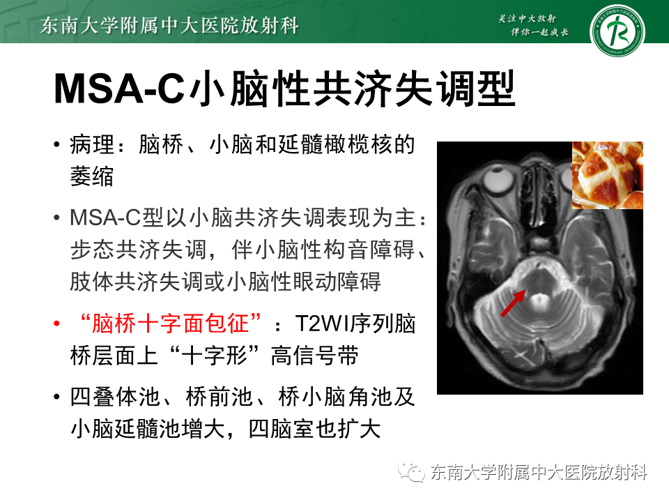 影像PPT - 【PPT】多系统萎缩-11