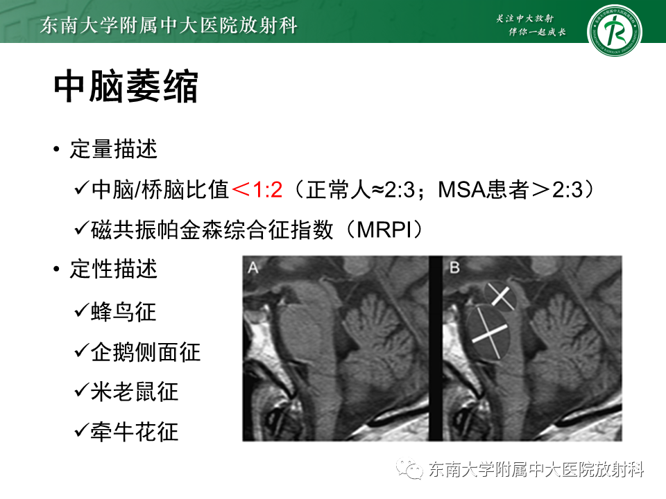 影像PPT - 【PPT】多系统萎缩-14