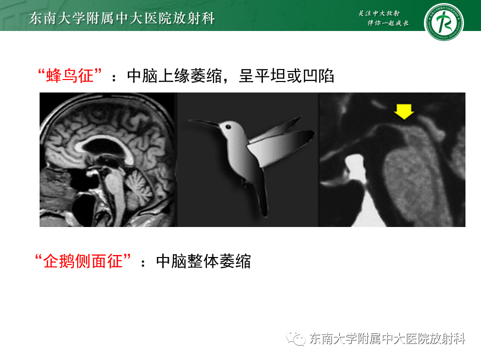 影像PPT - 【PPT】多系统萎缩-15