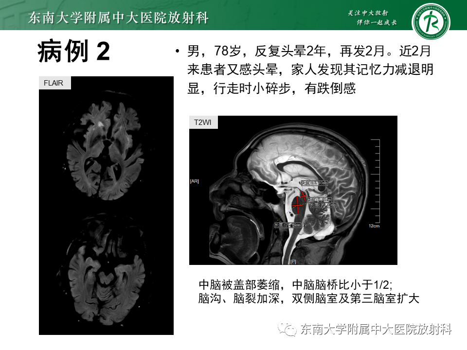 影像PPT - 【PPT】多系统萎缩-17